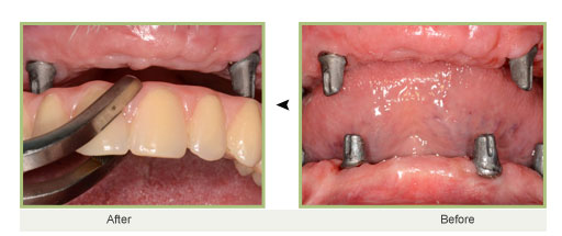 اصلاح بی دندانی کامل با ایمپلنت